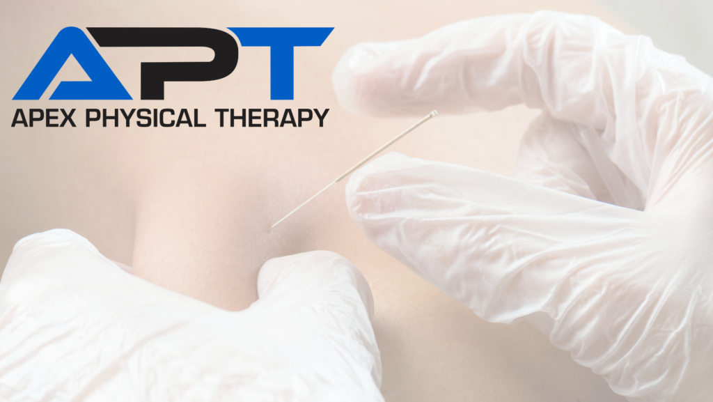 Pineville Dry Needling Apex Physical Therapy